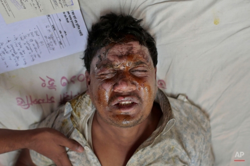 Hanif, 35, one of the victims of a pre-dawn fire bomb attack on a bus cries in pain as he receives treatment at the Medical College hospital in Dhaka, Bangladesh, Tuesday, Feb. 3, 2015. Attackers threw crude fire bombs at a packed bus early Tuesday morning, setting it alight as it moved along a Bangladesh highway and leaving at least seven people dead and 16 injured amid a nationwide strike called by the opposition. The incident happened in Comilla district, about 90 kilometers (55 miles) east of the capital.(AP Photo/ A.M. Ahad)